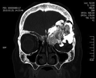 exophthalmust okozó extrém méretű sinus frontalis osteoma 3.