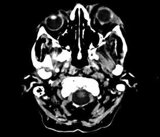 ábra: műtét előtti koponya ct-vizsgálat, sagittalis sík 5.
