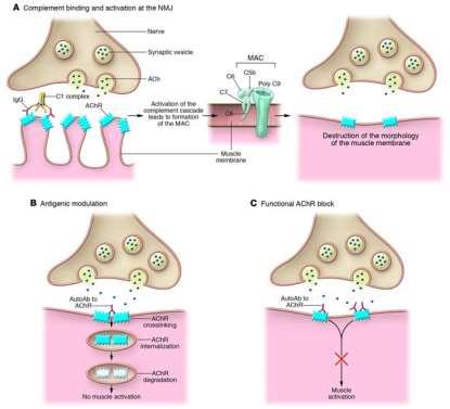 elősegítése, 3) acetilkolin neurotranszmitter hatás gátlása Thymus hiperplázia van gyakran a háttérben, mint kiváltó