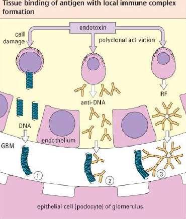 A vese globuláris bazális membránján (GBM) kötődő IC következményei Sérült sejtekből kikerülő pozitív töltésű törmelékek (DNS) a negatív töltésű GBMhoz A sejt eredetű antigének (IgG