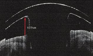 ábra: Az optikai front - lemez és a cornea kapcsolata az AS-OCT-vizsgálat során.
