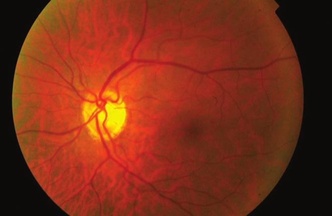 Central retinal artery occlusion with elevated inflammatory parameters: a case study BEVEZETÉS Az arteria centralis retinea okklúzió (CRAO) a retina centralis arteriá - jának, vagy valamelyik ágának