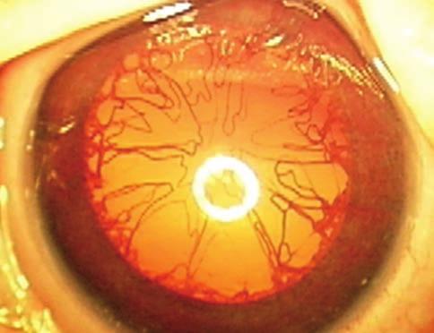 b stádium esetén pedig már a makulatáj is érintett (12. ábra), 5. stádium: a ROP végstádiuma, teljes ideghártya-leválás (elől/hátul, nyitott/zárt) jellemzi (13. ábra). Az agresszív poszterior ROP (AP- ROP) esetén a retina ereződése még csak az I.