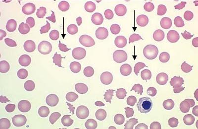 TTP Haemolyticus anaemia Coomb s negatív