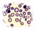 Meningococcus szepsis Pre-eclampsia
