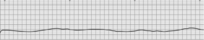 ALS- Nem sokkolandó ritmus Pulzus nélküli elektromos aktivitásról (PEA) beszélünk, ha