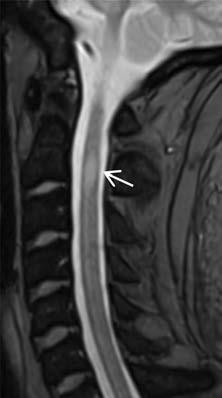 De myelinisatiós gócra jellemző, hogy az agyi MRI-n a laesió 3 mm vagy annál nagyobb átmérőjű, amelyek közül legalább egy perivent ricu la risan helyezkedik el, és ovoid alakú (3. ábra).