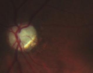 A szemfenékvizsgálat kétoldali, súlyos opticusatrophiát mutat (A, B).