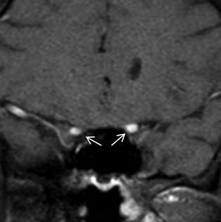 opticus hátsó ischaemiás neuro pathiája (posterior ischemiás opti cus neuropathia, PION) (5-10%) de lehet CRAO is vagy a n. opticus ischaemiás neuro - pathiája nélkül is, pl.