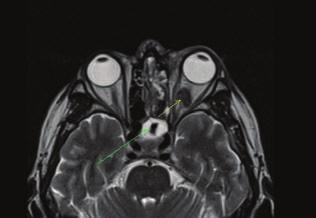 Rhino-orbital-cerebral mucormycosis A case report 4. A ábra: Szövettani metszet, PAS-reakció. A nyíl Zygomyces töredékre mutat a nekrotikus állományban 4. B ábra: Szövettani metszet, Giemsa-festés.