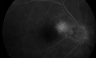 2011- ben a szemészeti vizsgálaton a jobb szem látásélessége 0,9, a bal szemé 1,0, közeli látásélessége CsIV/CsIV, szemnyomása normális volt.