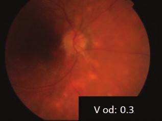 Birdshot chorioretinopathy 3. A ábra: 3. beteg, a 44 éves férfi szemfenéki képe (fundusfotó, OCT leképezés), 2012.