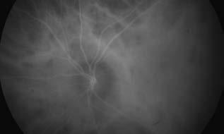 után a késői angiográfiás felvételeken a retina és RPE-atrófiának megfelelően hiper fluo resz cen - cia látható.