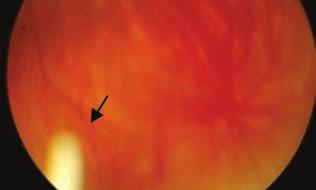 retinalis pigment epithelium atrófia.