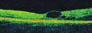 Az OCT-tomogramok elemezése során kimutatták, hogy a látásromlás hátterében álló ödéma a macula diffúz megvastagodásaként vagy