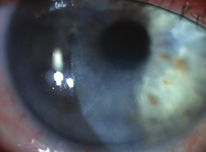 A kéthónapos kontrollra a korrigált látóélesség 0,8-re javult, a cornea stroma- és hám - ödéma megszűnt. Kilenc hónap elteltével a korábban érintett területen finom ujjlenyomat-mintázat és sub - 3.