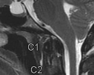 intracranialis vé - nás okklúzió, intraspinalis daganat (43). A PTC-t az obstrukciós hyd - rocephalustól a normális méretű agykamrák jelenléte különíti el.
