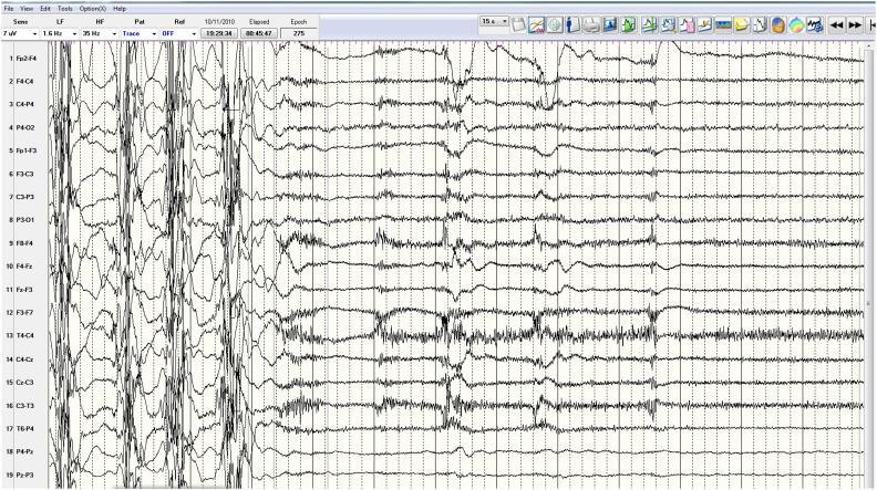 EEG figyelhető meg, az epileptiform kisülések száma átmenetileg csökken (postictalis exhaustiós EEG). 4.ábra [25] Leggyakoribb etiológia: Bármely epileptogén noxa vagy betegség kiválthatja.