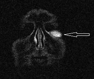 Dirofilariosis újabb esete Magyarországon 3. ábra: Kontraszt - anyag intravénás beadását kö vetően készített MRI-felvétel a bal alsó szemhéj presep ta - lis metszetéről.