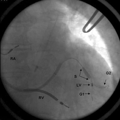 MÓDSZEREK A sinus coronarius elektróda pozíciójának stabilizálása stent implantációval Sinus coronarius stent implantációt a bal kamrai elektróda rögzítésére 248 betegnél végeztünk, postoperatív