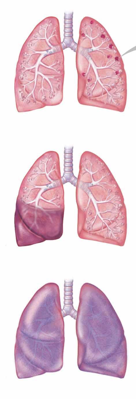 Bronchopneumonia Intraalveolaris exsudátum foltos/gócos eloszlásban Lobáris pneumonia Teljes lebenyt érintő