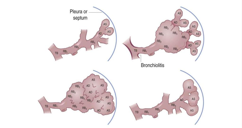 Emphysema Emphysema a szövet patológiás légtartalmát jelenti. Definíció: a légterek abnormális, permanens tágulata a terminalis bronchiolusoktól distálisan, az alveolus falak destrukciójával társulva.