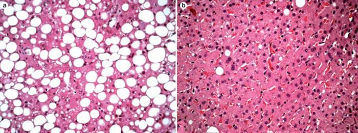Zsírmáj szövettani képe Alkohol okozta májkárosodás EM képe: A, C: Kontroll: