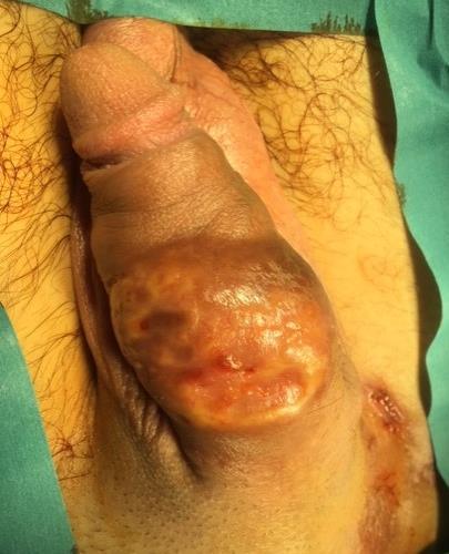 hajzselé tartálya [tancho]) a penisscrotum bőr alá injectálása,