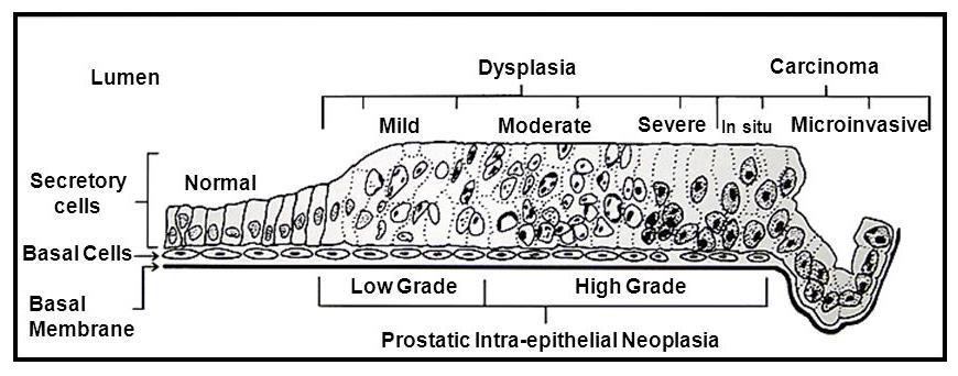 PROSTATICUS INTRAEPITHELIALIS NEOPLASIA (PIN) LOW-GRADE, HIGH-GRADE Preinvazív, prekurzor lézió Low-grade (korábbi grade 1 PIN) Jelentősége csekély, nincs egyértelmű asszociáció
