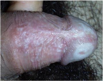 Ismeretlen etiológiájú, Balanitis sclerotica obliterans (penis