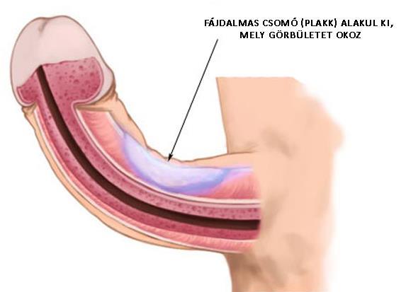 Peyronie betegség (penis fibromatosis, plastic induráció) Görbült penis és emiatt gyakran fájdalmas erekció Egyéb okok lehetnek: trauma,