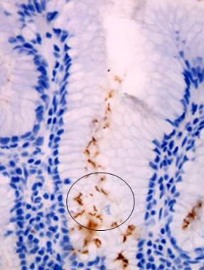 Helicobacter pylori asszociált gastritis Egyik leggyakoribb krónikus gastritis H.