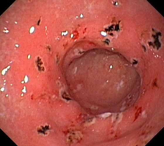 A gyomornyálkahártya heveny gyulladása Legtöbbször átmeneti Fő sejtes eleme: neutrophil granulocyta