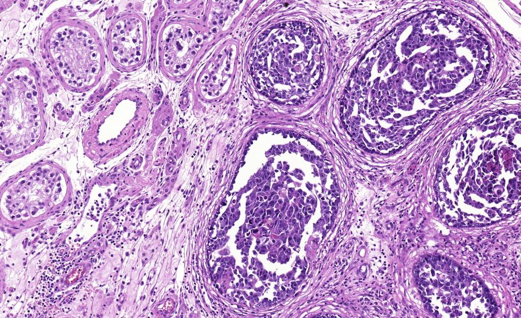 5. ábra. Embryonalis carcinoma intratubularis terjedése (jobb oldal). Baloldalon kiterjedt GCNIS látható. 1.6. A csírasejtes daganatok fejlődéstani szempontból J.
