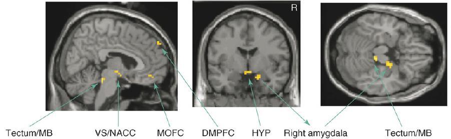 Klasszikus fmri lokalizációs sémák az érzelmek és motivációk területén - DMPFC dorsomedialis praefrontalis cortex: társas érzelmek, mentalizáció, self - MOFC medialis orbitofrontalis cortex: