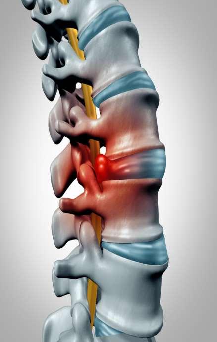 Tünetek nyakból - karba, vállba, derékból - lábba, lábszárba sugárzó fájdalom a derékfájás néha nem is jelentkezik, csak bizonytalan alsóvégtagi fájdalom a fájdalom változó erősségű, napokon, heteken