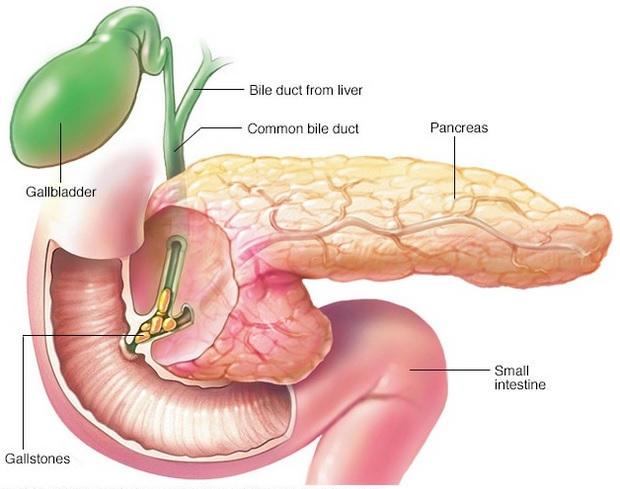 Acut biliaris pancreatitis