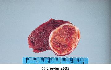 1-10 cm-es tumor vérzés, necrosis, cysticus deg.