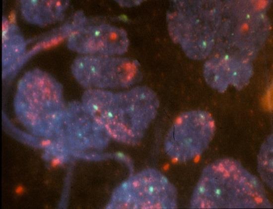 MYCN Amplificatio Aggressive Neuroblastos Tumor
