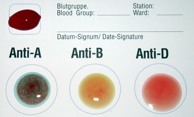 7.2. ábra. Vércsoport-meghatározás. A vizsgált vér az anti-a szérumban jól láthatóan kicsapódott, az anti-b és anti-d szérumban pedig nem, azaz a vizsgált vér vércsoportja A, Rh -.