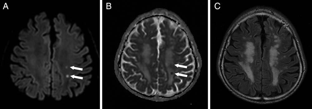 The hidden fingerprint of ablation procedures? Schrickel JW et al.