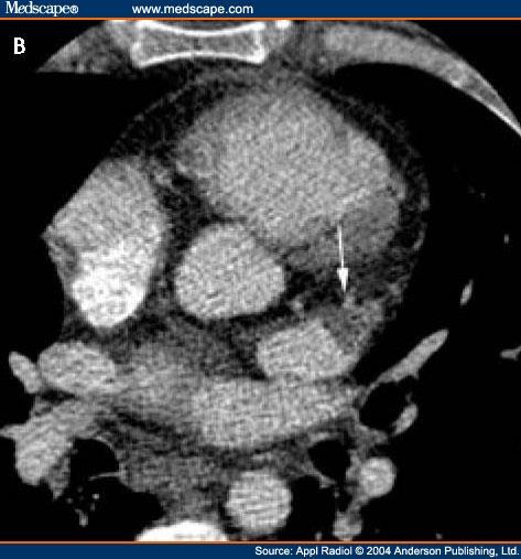 Thrombus