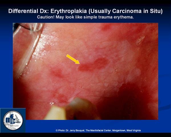 Erythroplakia fogalma Vörös folt, nincs jelentős gyulladás a hátterében, nincs felszíni hyperkeratosis, ellenkezőleg