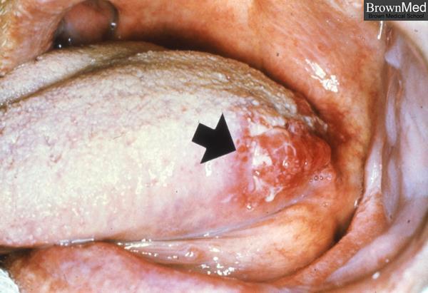 Makroszkópia: A szájüreg malignus epithelialis