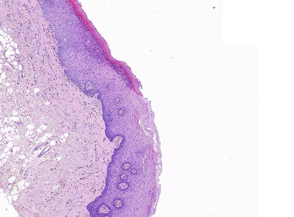 Benignus epithelialis daganatok Leukoplakia mikroszkópos morphológiája A klinikailag leukoplakiás elváltozás hátterében állhat: hám hyperplasia, ahol a laphám kiszélesedett, de kiérett jellegű.