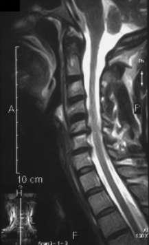 spondylosis,