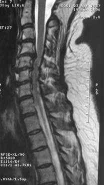 spondylosis,