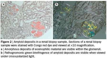 Amyloidosis Abnormális, fibrilláris protein lerakódása az extracelluláris térben Kongóvörös festéssel polarizációs mikroszkóp alatt zöld kettőstörést mutat 36 ismert fehérje képes fibrilláris