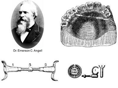 Angell végezte az első sutura repesztést (1860)