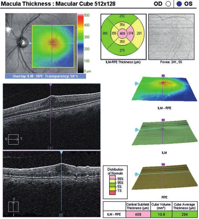 Management of diabetic macular edema tandó következő terápiás lépéseket.